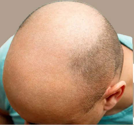 before-hair-transplant