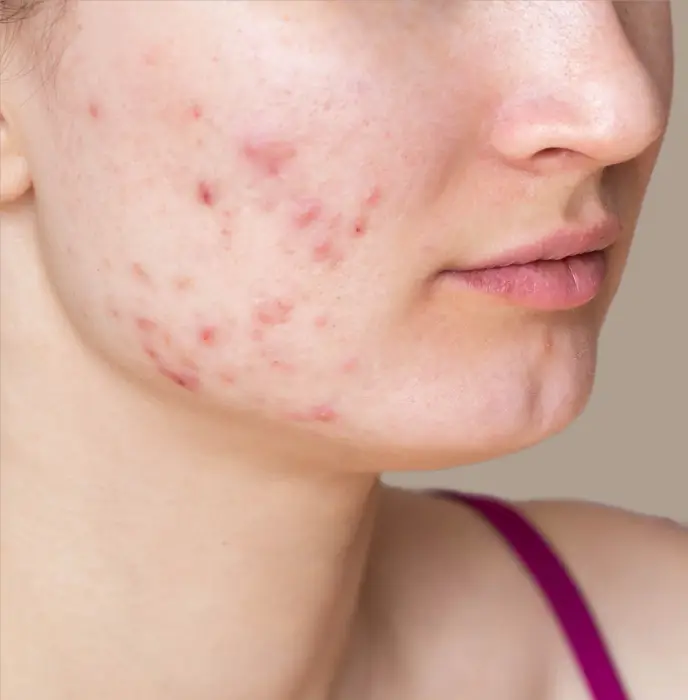 microdermabrasion before